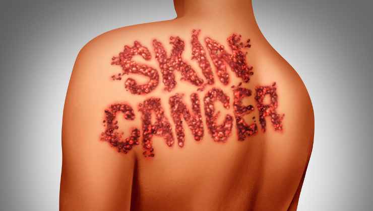 Sintomi cancro alla pelle 